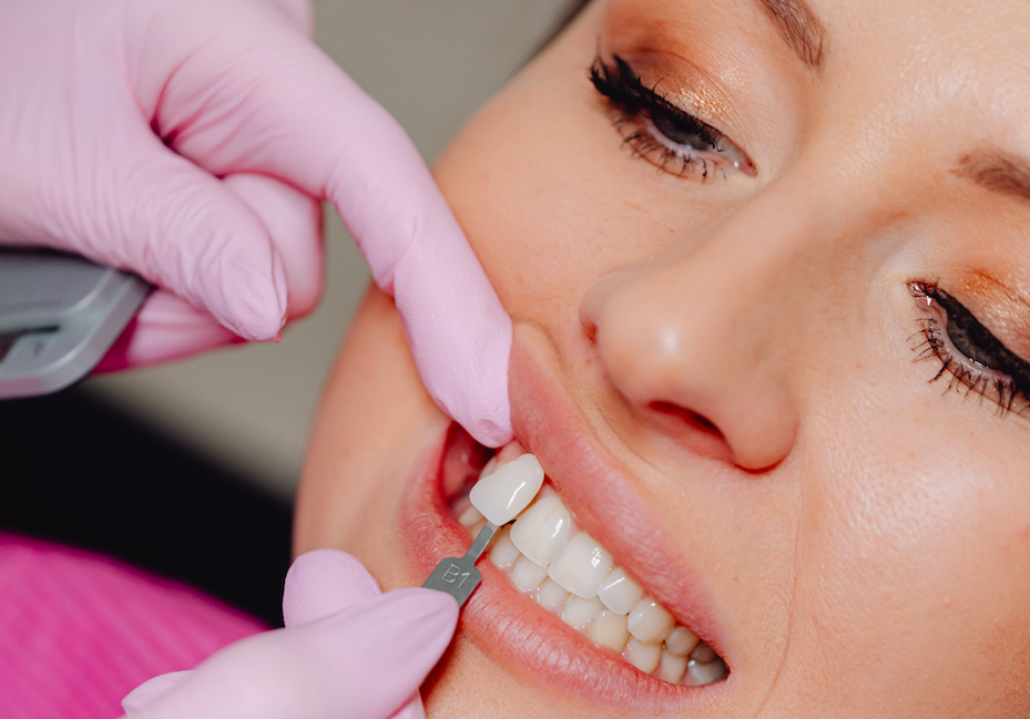 Come Migliorare L'Estetica dei denti