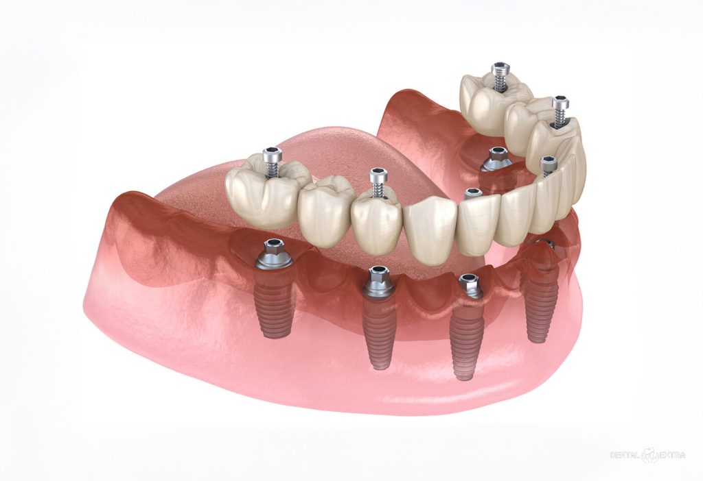 A cosa servono gli impianti dentali?