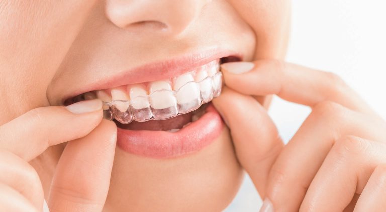 L’apparecchio denti trasparente: una soluzione estetica e discreta