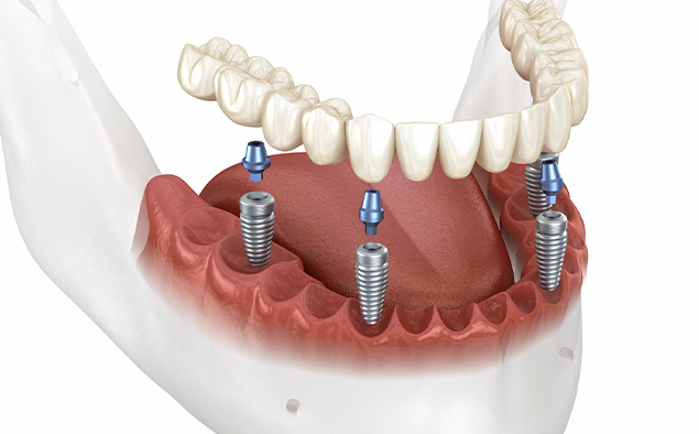 all on four dentista dental