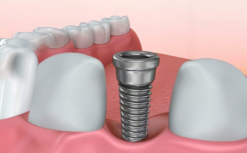 Quanto costa fare l'impianto ai denti?