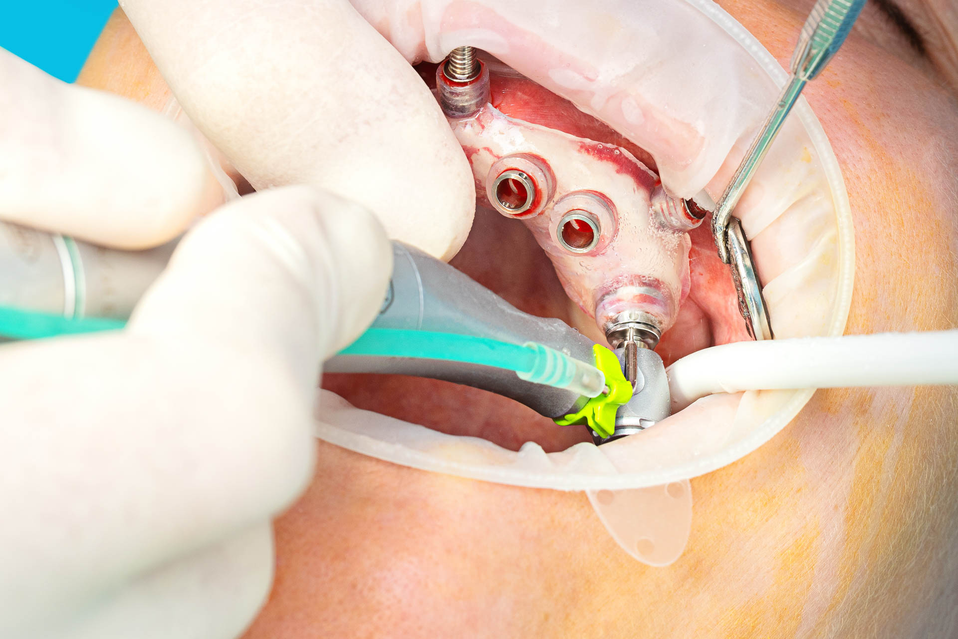 intervento chirurgia guidata dental extra dentista