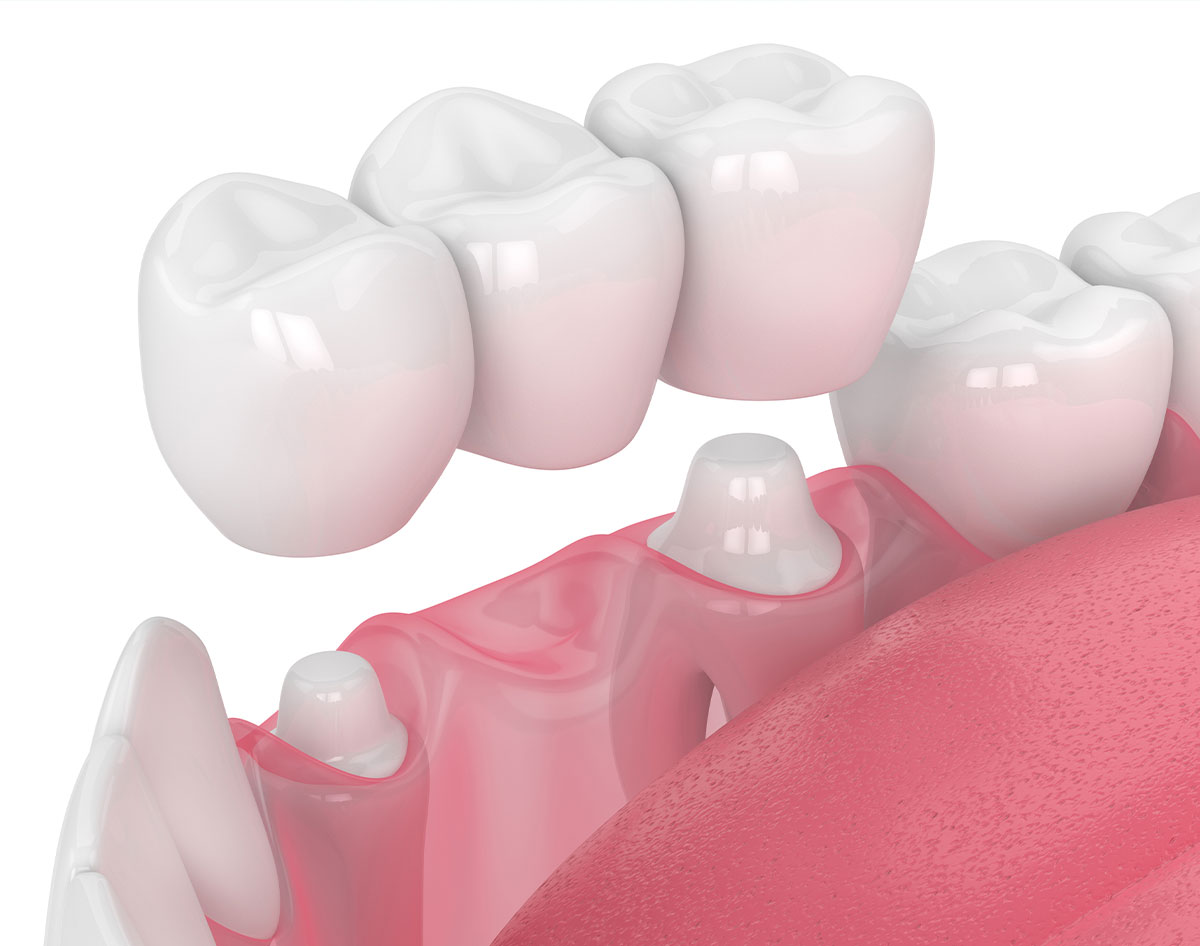 ponte denti naturali dental extra dentista