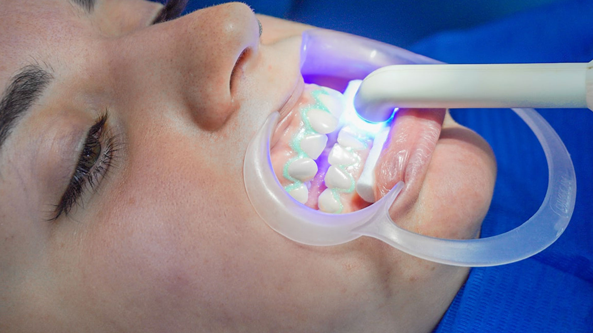 sbiancamento dental extra dentista